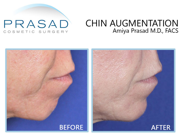 dermal fillers for chin before and after treatment on male patient in 50s