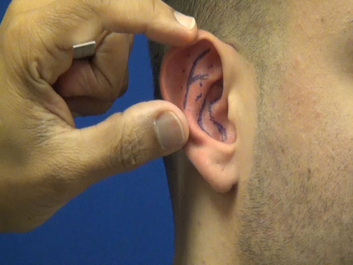 Ear Pinning Surgery Process