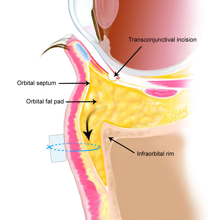 an illustration of fat transposition under eyes