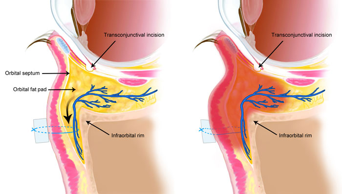 risk of fat transposition illustration of vessel swelling