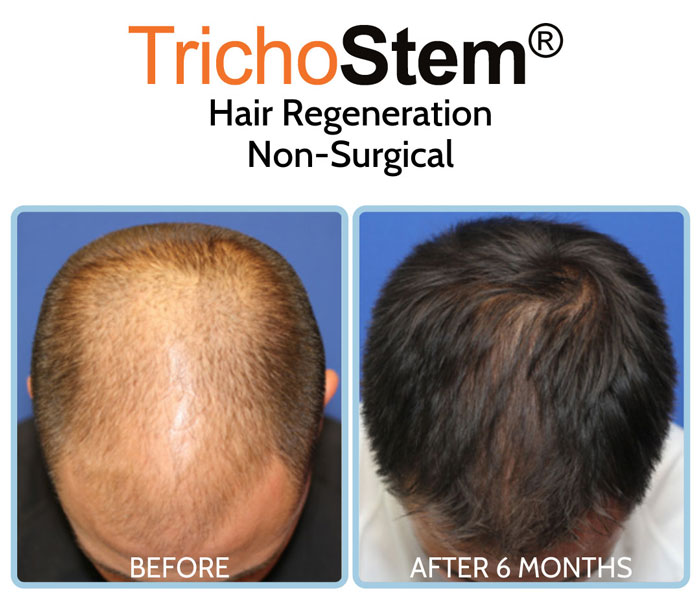 hair transplant alternative treatment before and after results on male patient