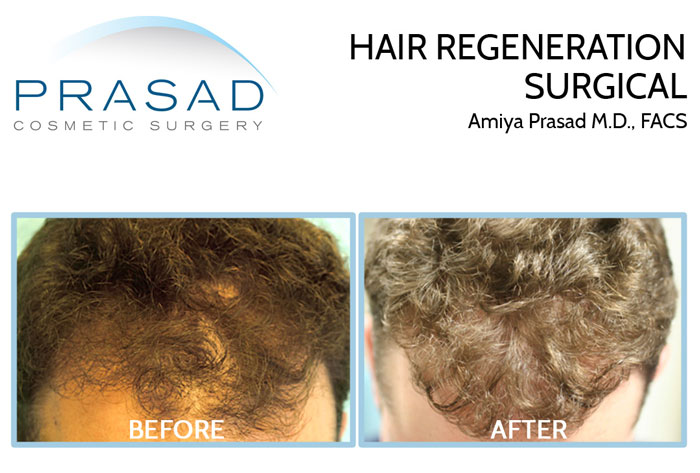 hair regeneration and hair transplant before and after results on male patient with receding hair line hair loss