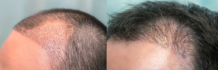 Density Limitations in Hair Transplants