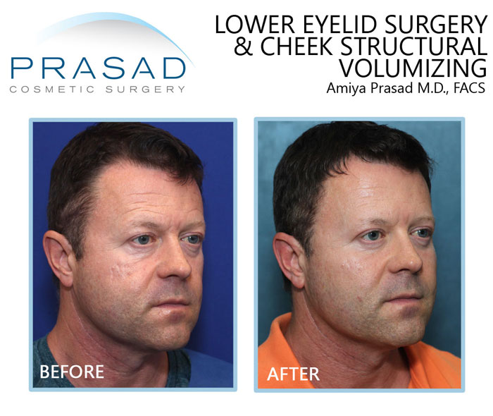 lower eyelid blepharoplasty and cheek volume enhancement for facial aging treatment on male patient before and after results