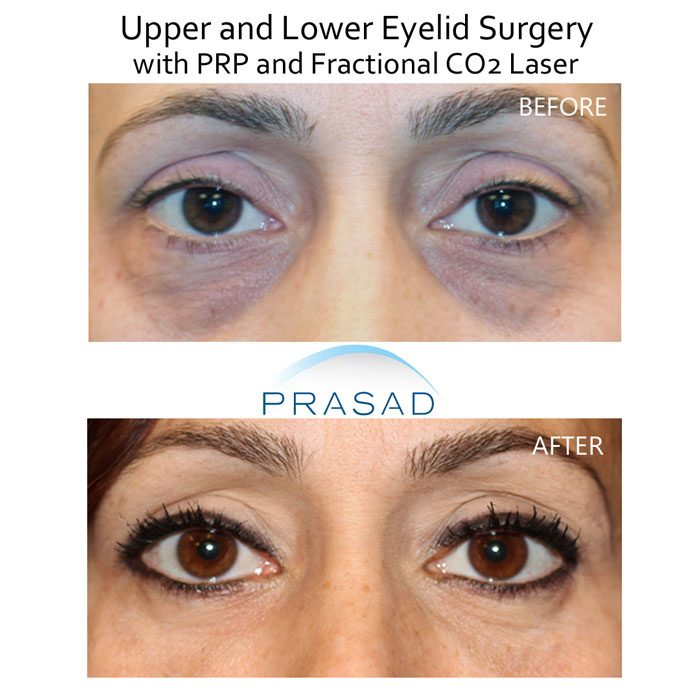 lower eyelid surgery and PRP for lower under eyes before and after results