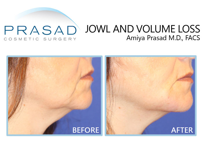 jowl and facial volume enhancement treatment for signs of aging in 40s