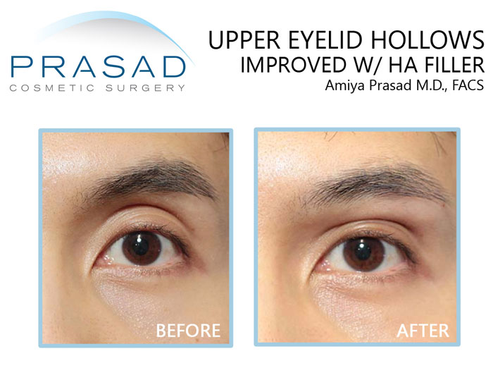 before and after treating upper eyelid hollowness with filler