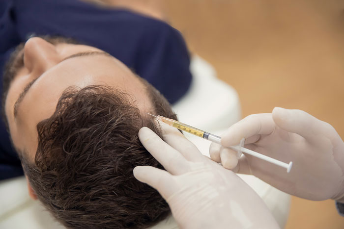 platelet rich plasma (prp) for hair loss injection on young male patient