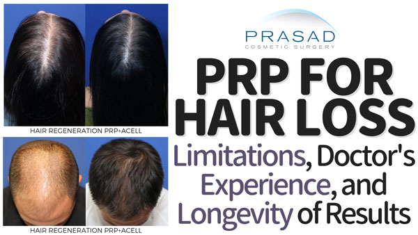 prp for hair loss - limitations, doctors experience, success rate