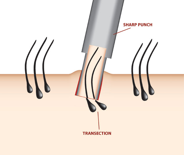 hair transplantation sharp punch illustration