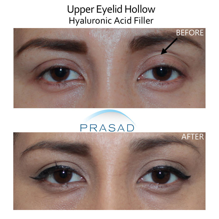 upper eyelid hollow before and after treatment results on female patient