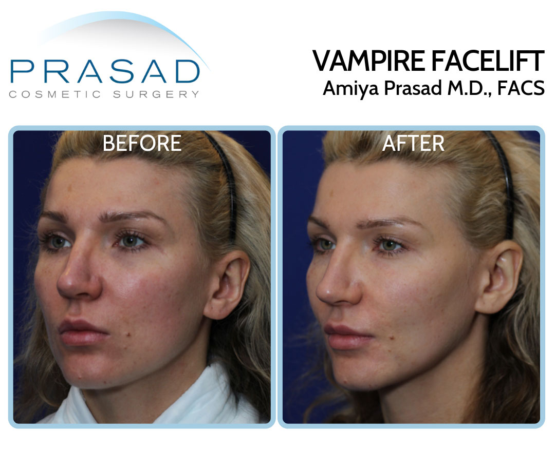 vampire facelift before and after treatment on female patient in 30s