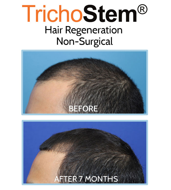 TrichoStem® Hair Regeneration before and after 7 months results on male patient with thinning hair