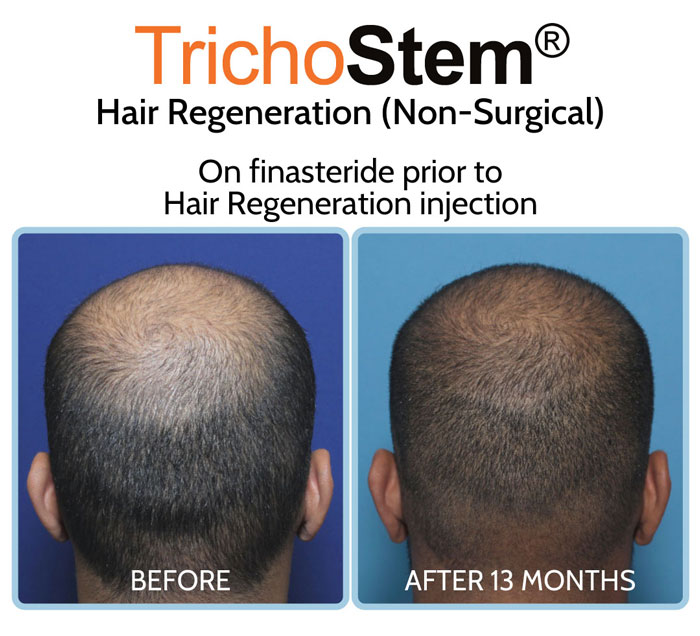 TrichoStem® Hair Regeneration before and after results on patient using finasteride prior to injection