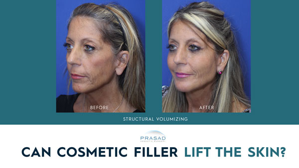 y lift before and after treatment with the text 'can cosmetic fillers lift the skin'