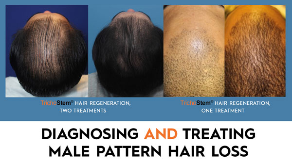 male pattern hair loss treatment before and after with the text Diagnosing and Treating Male Pattern Hair Loss