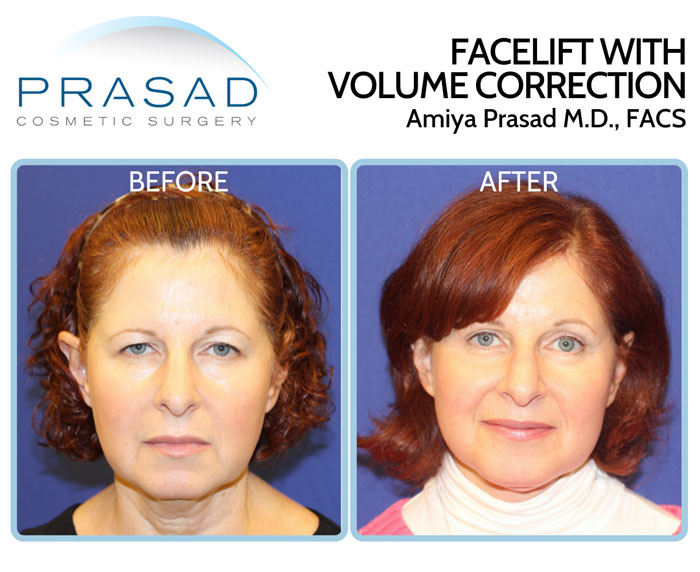 facelift with volume correction before and after treatment - female patient in 60s - facelift and filler to lift the face