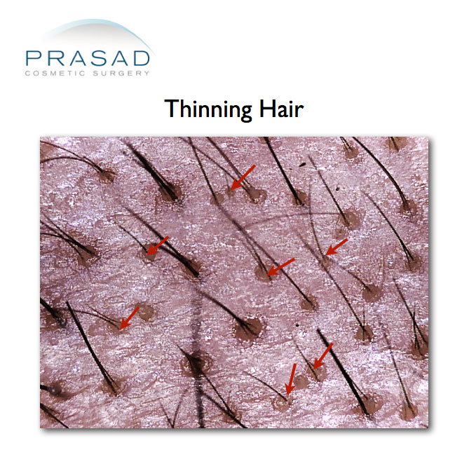 a microscope image of hair thinning