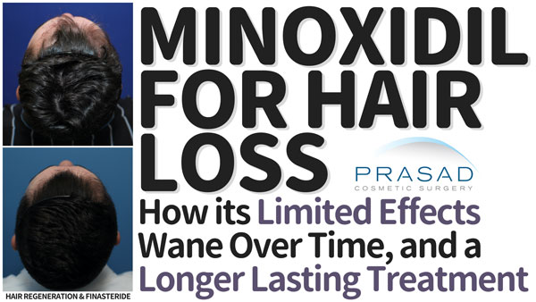 minoxidil for hair loss - limited effects wane over time and longer lasting treatment