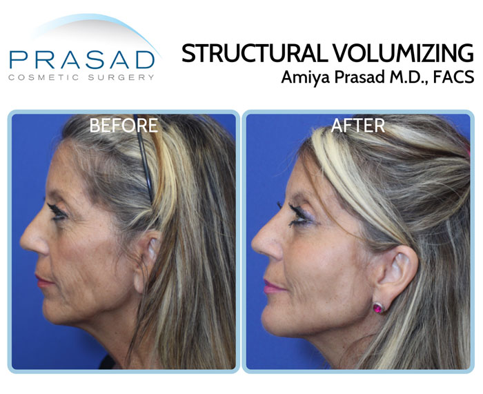 fillers to lift face - y lift before and after treatment - female patient in 50s