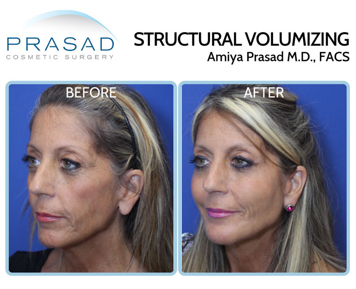 fillers to lift face - y lift before and after treatment - female patient in 50s