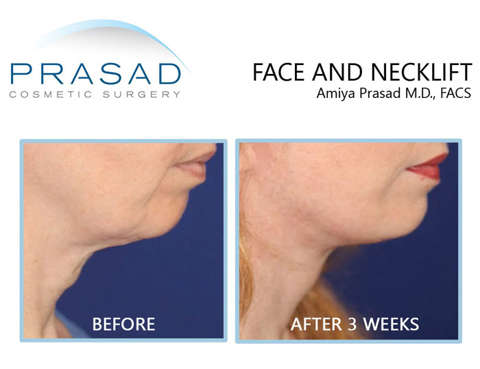 facelift and necklift recovery before and after 3 weeks on female patient