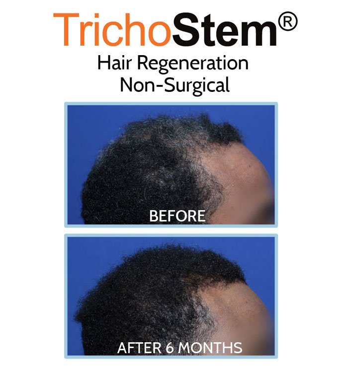 African-American Hair Loss Treatment before and after results