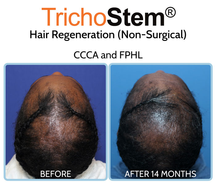 Hair Regeneration before and after treatment for African American Hair Loss with CCCA and FPHL