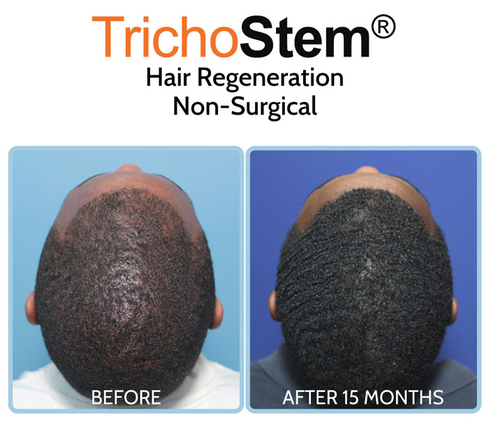 Trichostem Hair Regeneration treatment for thinning African American hair before and after results