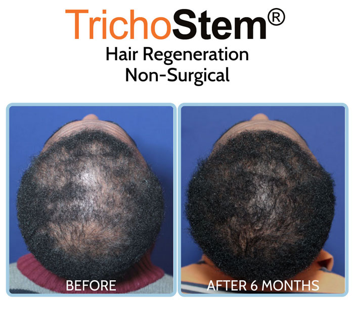 Trichostem Hair Regeneration treatment for African American Hair Loss before and after results