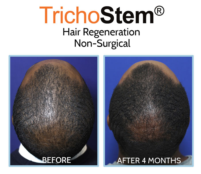 Trichostem Hair Regeneration for African american male hair loss treatment before and after