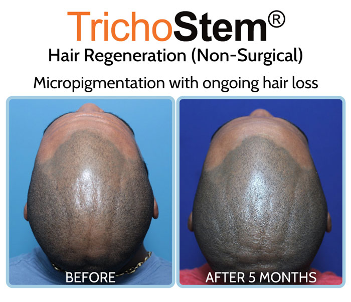 Trichostem Hair Regeneration for micropigmentation with ongoing hair loss before and after treatment results