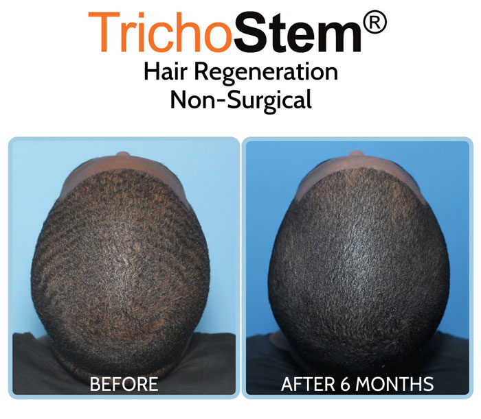 Trichostem Hair Regeneration treatment for African American male hair loss patient before and after results