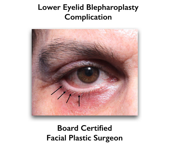 complication of lower eyelid surgery using transcutaneous blepharoplasty performed by other facial plastic surgeon