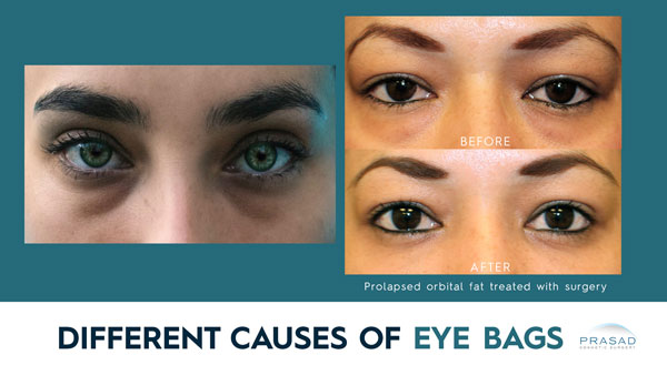 under eye bags surgery before and after with the text different causes of eye bags