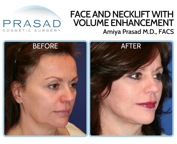 facelift with necklift and fillers - before and after results female patient