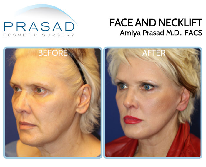 facelift surgery before and after photos of female patient in early 60s