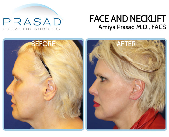 facelift and necklift before and after photos of female patient in early 60s