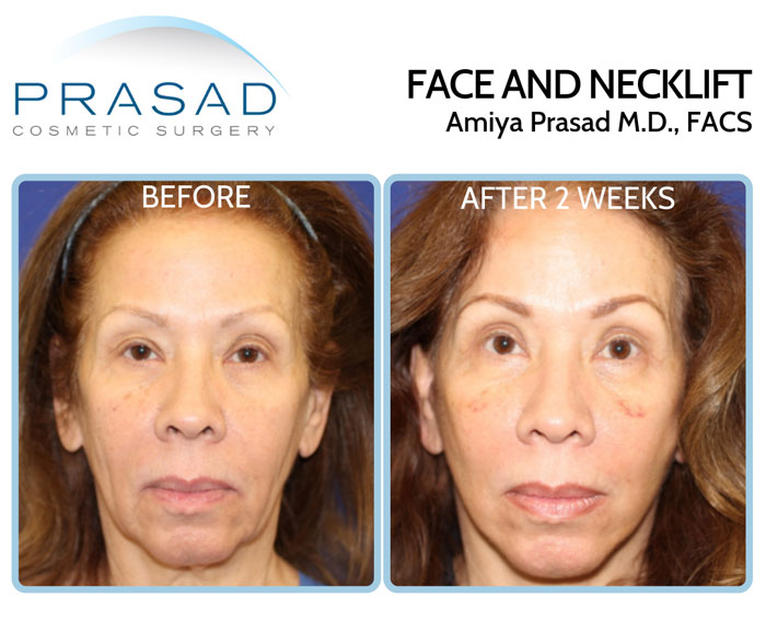 facelift surgery recovery before and after 2 weeks female patient