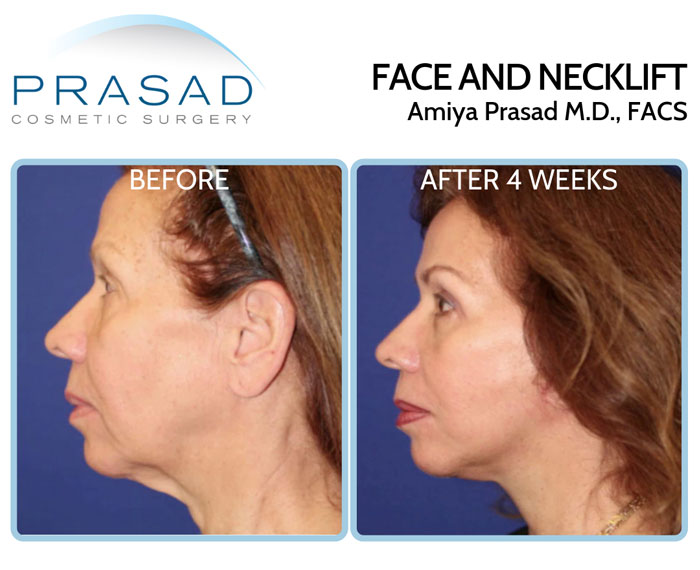 facelift surgery recovery with local anesthesia with LITE IV sedation before and after 4 weeks female patient