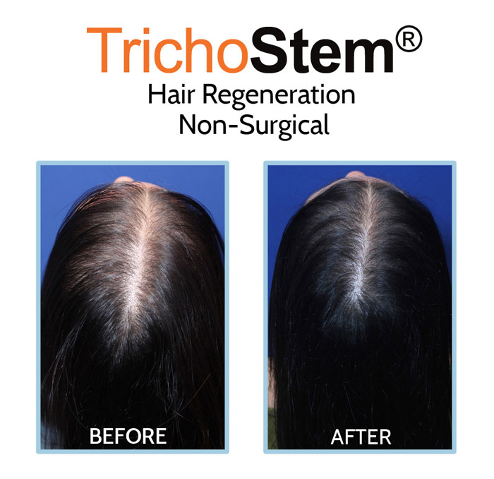 hair regeneration before and after treatment on young woman patient with female pattern hair loss