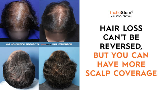 male and female patient before and after Trichostem Hair Regeneration treatment with the text Hair Loss cant be reversed but you can have more scalp coverage