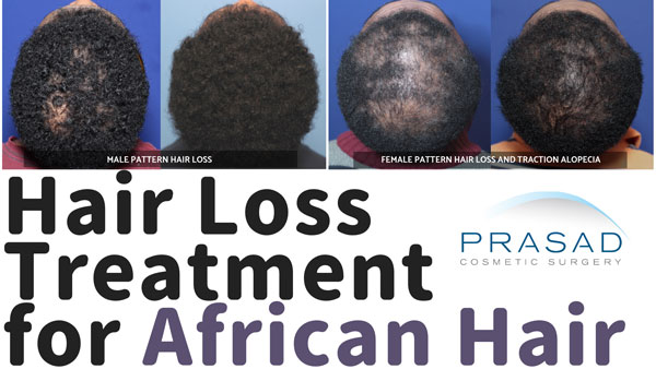 hair loss treatment for African hair