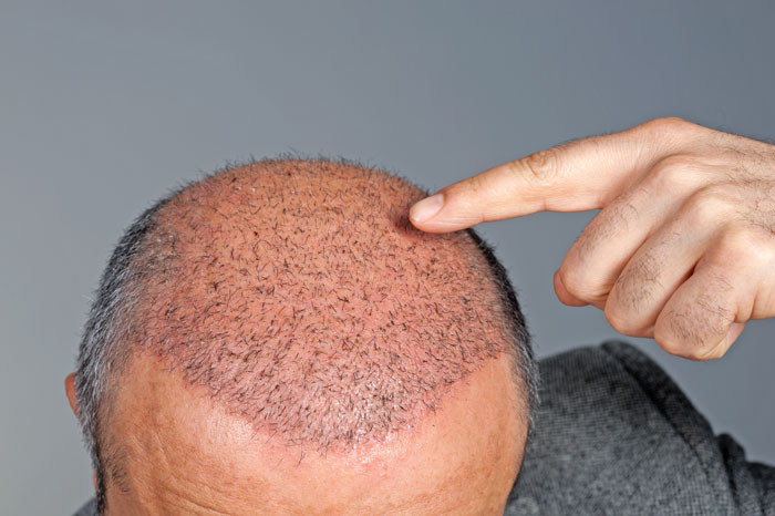 hair scalp coverage after hair transplant on a male patient