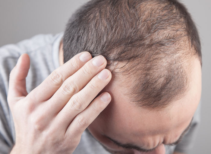 a man with thinning hair