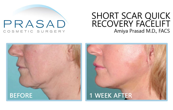 Mini facelift before and after results on female patient - 1 week recovery