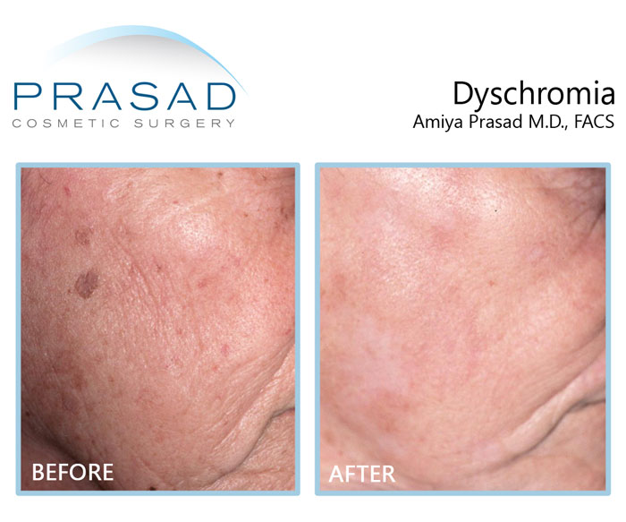 laser for hyperpigmentation treatment before and after