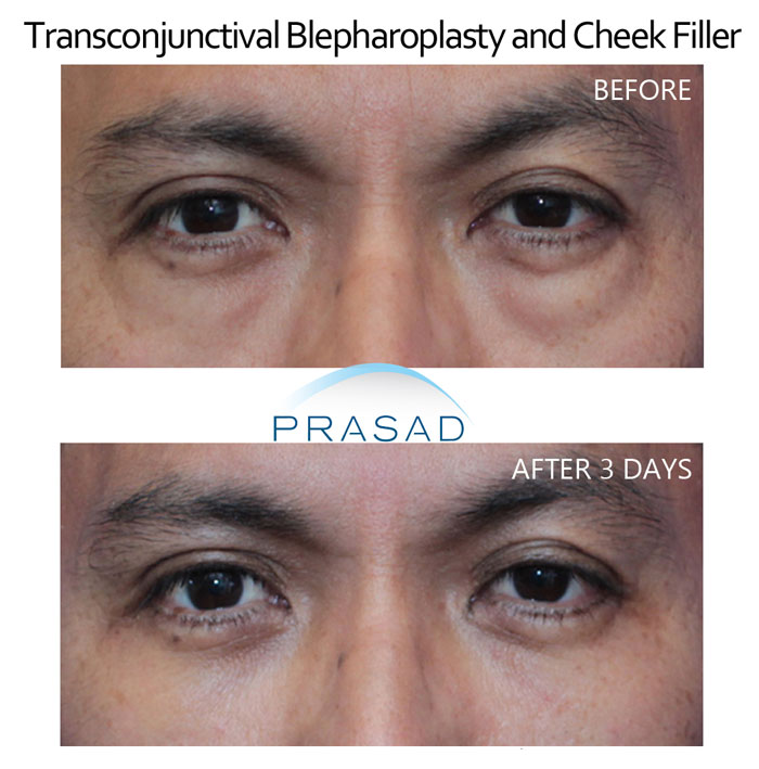 3 days recovery after under eye bags surgery performed by Dr. Amiya Prasad NYC office