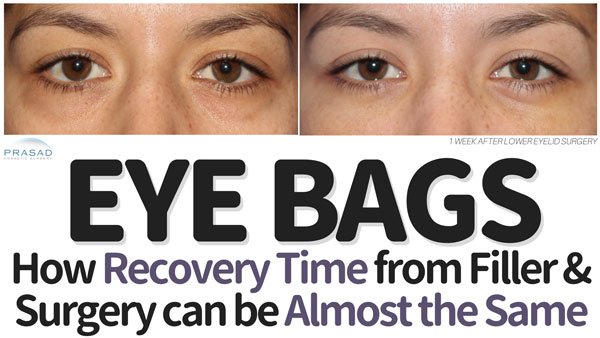 before and after 1 week recovery from under eye bag surgery with the text How Recovery Time from Filler and Surgery can be Almost the Same