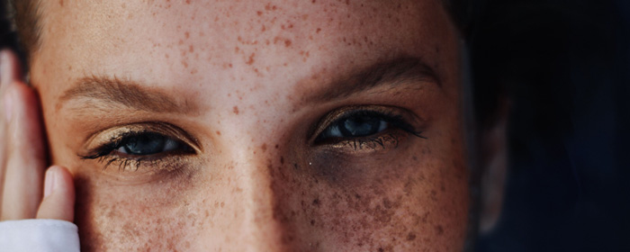 young adult female with hyperpigmentation sun damaged on face